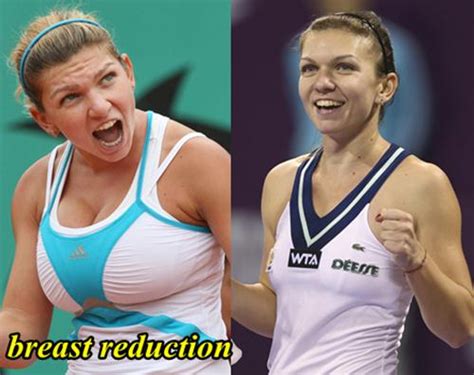 Simona Halep Before and After Breast Reduction Surgery